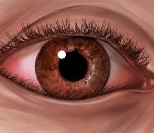 안검내반 증상과 원인, 수술이 필요한 이유…눈꺼풀 말림 방치하면 시력 위협