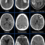 뇌출혈 초기증상부터 원인·외상 위험까지…예방 식단으로 관리하는 법