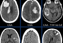 뇌출혈 초기증상부터 원인·외상 위험까지…예방 식단으로 관리하는 법