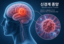신경섬유종증, 피부 반점부터 신경 종양까지…조기 진단 중요